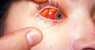 اسباب الاصابة بملتحمة العين وعلاجها